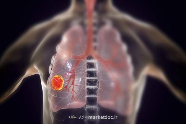 میکروتراشه ای برای تشخیص سریع سرطان ریه